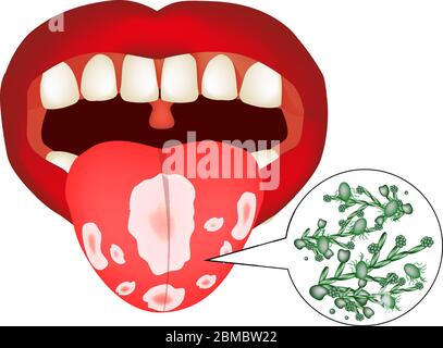 Muguet buccal. Candidose sur la langue. Champignon dans la bouche. Infographies. Illustration vectorielle sur un arrière-plan isolé. Illustration de Vecteur