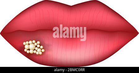 L'herpès sur la lèvre. L'infographie. Vector illustration sur fond isolé. Illustration de Vecteur