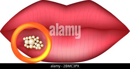 L'herpès sur la lèvre. L'infographie. Vector illustration sur fond isolé. Illustration de Vecteur