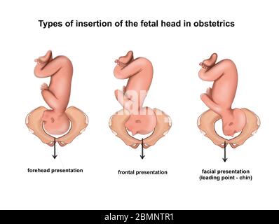 Illustration de l'insertion de la tête fœtale dans les obsteriques Banque D'Images
