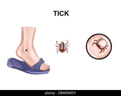 Illustration de la morsure de tiques d'encéphalite Banque D'Images