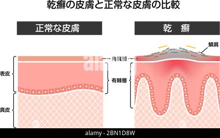 Vue en coupe du psoriasis et de la peau normale / illustration vectorielle plate (japonais) Illustration de Vecteur