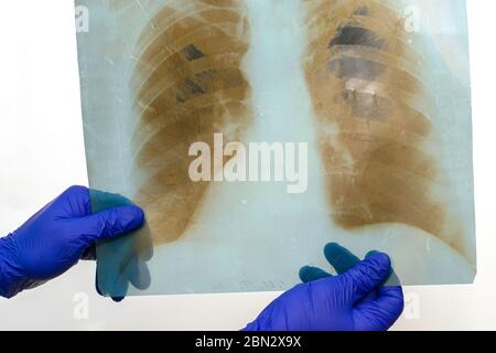 mains en caoutchouc bleu gant médical chirurgical de protection retient les rayons x des poumons humains Banque D'Images