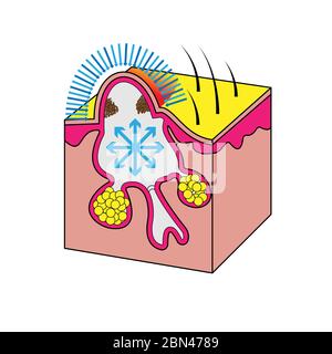 Formation de papule d'acné et de boutons, illustration de vecteur médical Illustration de Vecteur