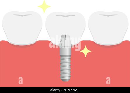 Illustration du vecteur plat de l'implant dentaire / pose de dents artificielles (couronne) Illustration de Vecteur