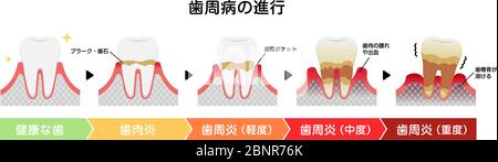 Les stades de la maladie parodontite illustration du vecteur Illustration de Vecteur