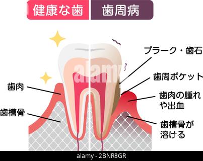 Comparaison des dents normales et des maladies parodontales. illustration à vecteur plat Illustration de Vecteur