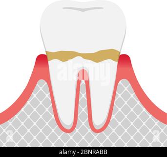Les stades de la maladie parodontite / gingivite Illustration de Vecteur