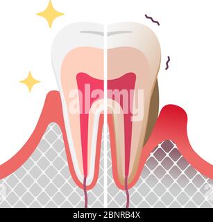 Comparaison des dents normales et des maladies parodontales. illustration à vecteur plat Illustration de Vecteur