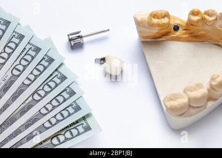 l'implant dentaire en céramique est doté d'un outil dentaire et d'un modèle de dents avec un implant sur fond blanc. à gauche de la dent se trouvent des billets de do Banque D'Images