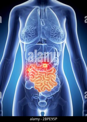 Rendu 3d illustration de l'anatomie féminine - cancer de l'intestin Banque D'Images