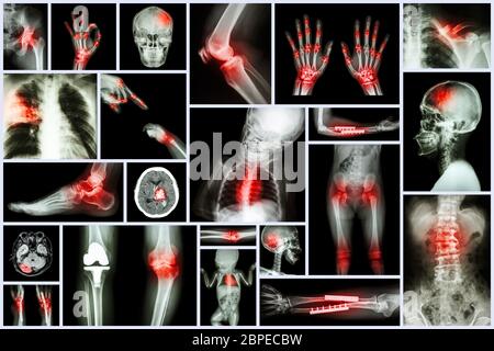 Collection X-ray multiple organe humain et chirurgie orthopédique et maladie multiple (tuberculose pulmonaire , goutte , polyarthrite rhumatoïde, spondylosis , F Banque D'Images