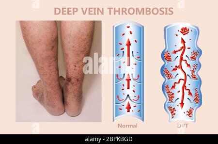 Syndrome mécanisme, thrombose veineuse profonde ou embolie pulmonaire, thrombose ou PE, thrombose coronaire, illustration du schéma de jambes mâle Banque D'Images