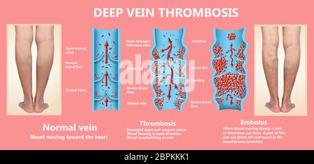 La thrombose. De la normale de la circulation sanguine vers la formation de caillots sanguins et clot, qui voyage dans le sang. Embolie. biologiques, médicaux, et de la science Banque D'Images