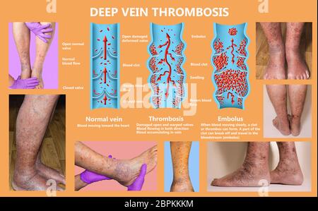 La thrombose. De la normale de la circulation sanguine vers la formation de caillots sanguins et clot, qui voyage dans le sang. L'embolie. Illustration pour la biologie, le medi Banque D'Images