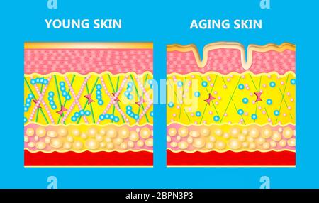 Le schéma d'une peau plus jeune et le vieillissement de la peau montrant la diminution de collagène et élastine cassé dans la peau plus ancienne. Banque D'Images
