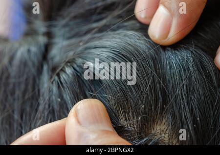 Oeufs de poux sur la tête de cheveux causes de démangeaisons. Banque D'Images