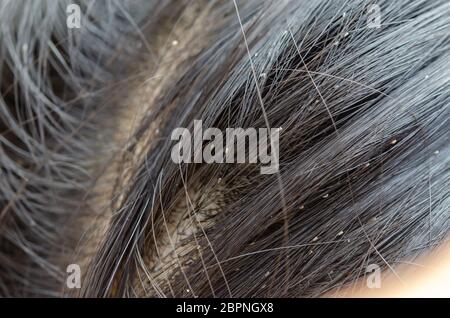 Oeufs de poux sur la tête de cheveux causes de démangeaisons. Banque D'Images