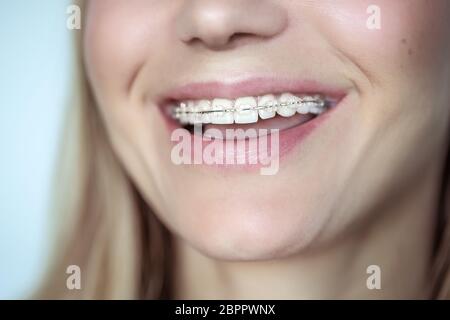 Les appareils fixes, le traitement d'une dents de travers, photo gros plan d'un beau sourire d'une jeune femme avec des dents propres, esthétique dentaire et des soins dentaires. Banque D'Images