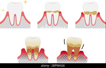 Les stades de la maladie parodontite illustration du vecteur Illustration de Vecteur