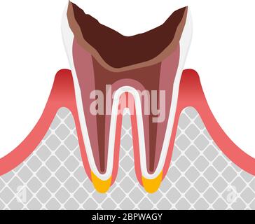 Le stade de la carie dentaire / dent morte Illustration de Vecteur