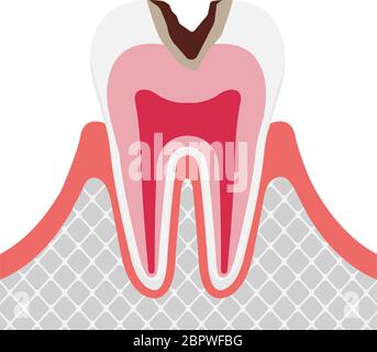 Le stade de la carie dentaire / carie dans la dentine Illustration de Vecteur