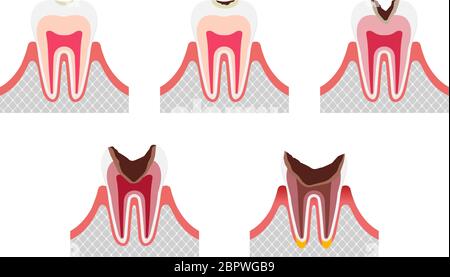 Les étapes de la carie dentaire / l'ensemble d'illustrations à vecteur plat Illustration de Vecteur