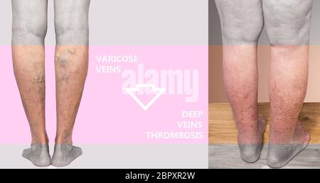 Collage des varices et du membre inférieur hyperpigmenté secondaire à l'insuffisance veineuse. Banque D'Images