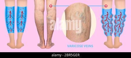 Varices sur les jambes d'une femme senior. La structure de la normale et les varices. Concept de la peau sèche, les vieux cadres, varices et des ve Banque D'Images