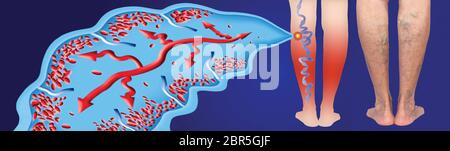 Varices sur les jambes d'une femme senior. La structure de la normale et les varices. Concept de la peau sèche, les vieux cadres, varices et des ve Banque D'Images