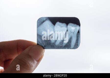Rayons X des dents de sagesse dans les mains du dentiste Banque D'Images