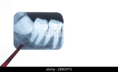 Rayons X des dents de sagesse dans les mains du dentiste Banque D'Images