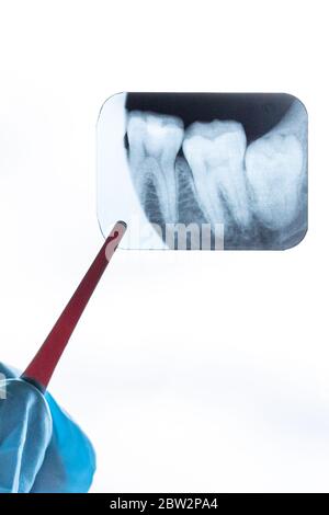 Rayons X des dents de sagesse dans les mains du dentiste Banque D'Images