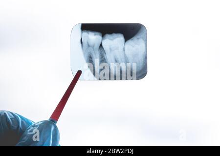 Rayons X des dents de sagesse dans les mains du dentiste Banque D'Images