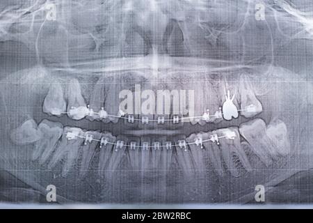 Photographie radiographique des dents humaines avec un système d'accolades. Dent de sagesse retardée Banque D'Images