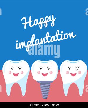 Affiche bonne implantation. Concept pour une bannière ou une affiche publicitaire. Dents saines et implant installés. Illustration vectorielle Illustration de Vecteur