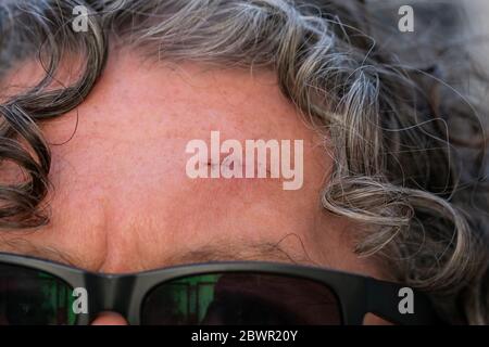 Gros plan d'une plaie d'opération fraîche avec des points de suture montrant une cicatrice sur le front d'un homme. Homme plus âgé portant des lunettes de soleil et des cheveux cordus grisants. Banque D'Images