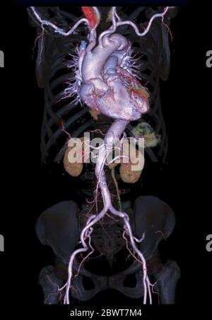 CTA aorte abdominale image de rendu 3D sur squelette transparent . Banque D'Images