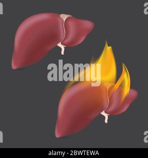 Brûlure du foie anatomique. Organe humain réaliste du système de digestion interne en flamme. Illustration vectorielle Illustration de Vecteur