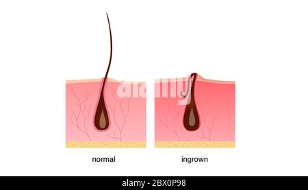 Poils incarnés après le rasage Illustration de Vecteur