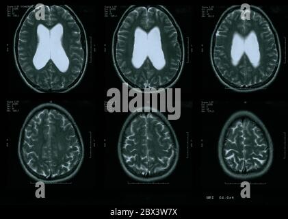 IRM du cerveau de la femme de 35 ans avec un hydrocéphalie léger Banque D'Images