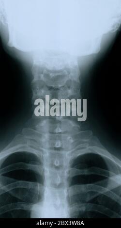 Radiographie du cou et de la colonne vertébrale de la femme de 35 ans Banque D'Images