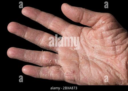 Eczéma avec rougeur, boursouflures, bosses et flocons sur la main et les doigts d'un homme, causés par le soleil, l'atopie ou les allergènes de contact. Isolé sur blanc Banque D'Images