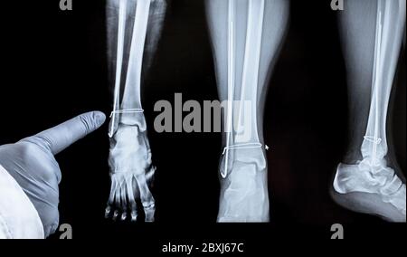 Rayons X de la jambe après l'opération - fils dans la jambe. Le médecin pointe un doigt sur la zone d'opération. Banque D'Images