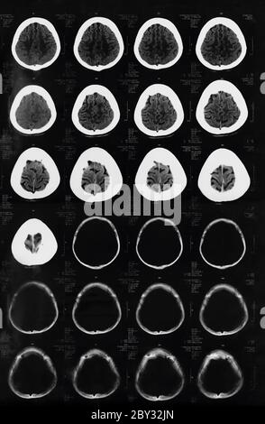 X-ray de la tomodensitométrie cérébrale Banque D'Images