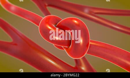 3d illustration d'un noeud dans une artère étant restreint et limité appelé artériosclérose Banque D'Images