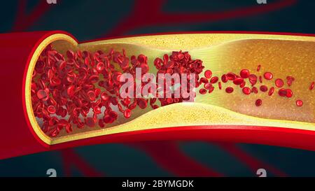 Embolie causée par un caillot de sang dans un vaisseau sanguin constrié - illustration 3d Banque D'Images