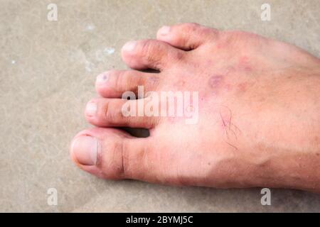 gros plan peau psoriasis des pieds de l'athlète champignon, pied de hong kong, maladie des pieds Banque D'Images