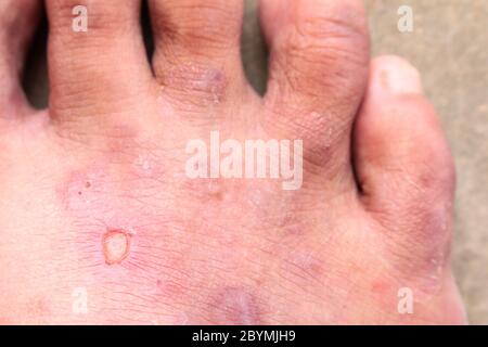 gros plan peau psoriasis des pieds de l'athlète champignon, pied de hong kong, maladie des pieds Banque D'Images