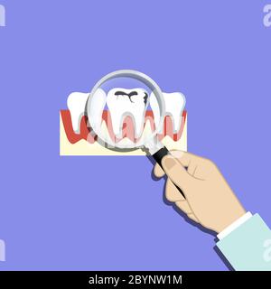 Trouver des dents, caries, émail sale. Loupe à portée de main. Dent avec icône de caries sur fond isolé. Vecteur EPS 10. Illustration de Vecteur